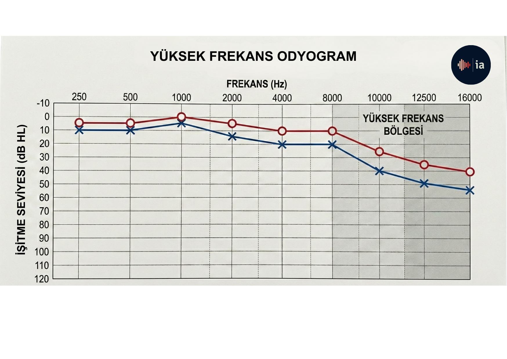 Example of a high-frequency audiogram