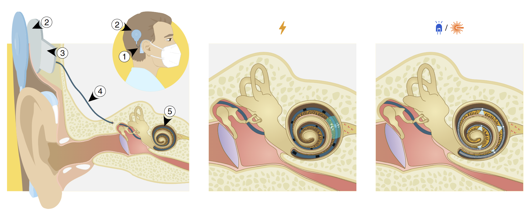 Optik koklear implant çalışma prensibi