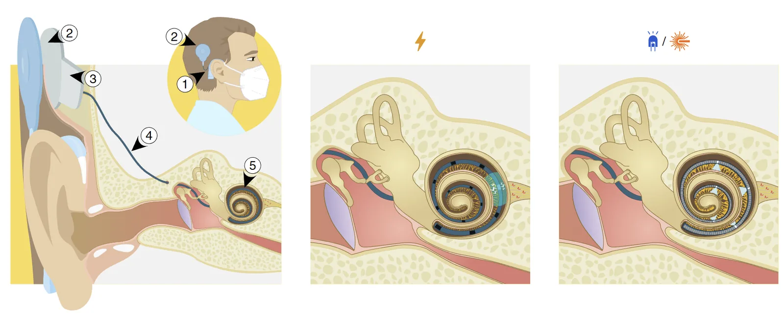 Optik koklear implant çalışma prensibi