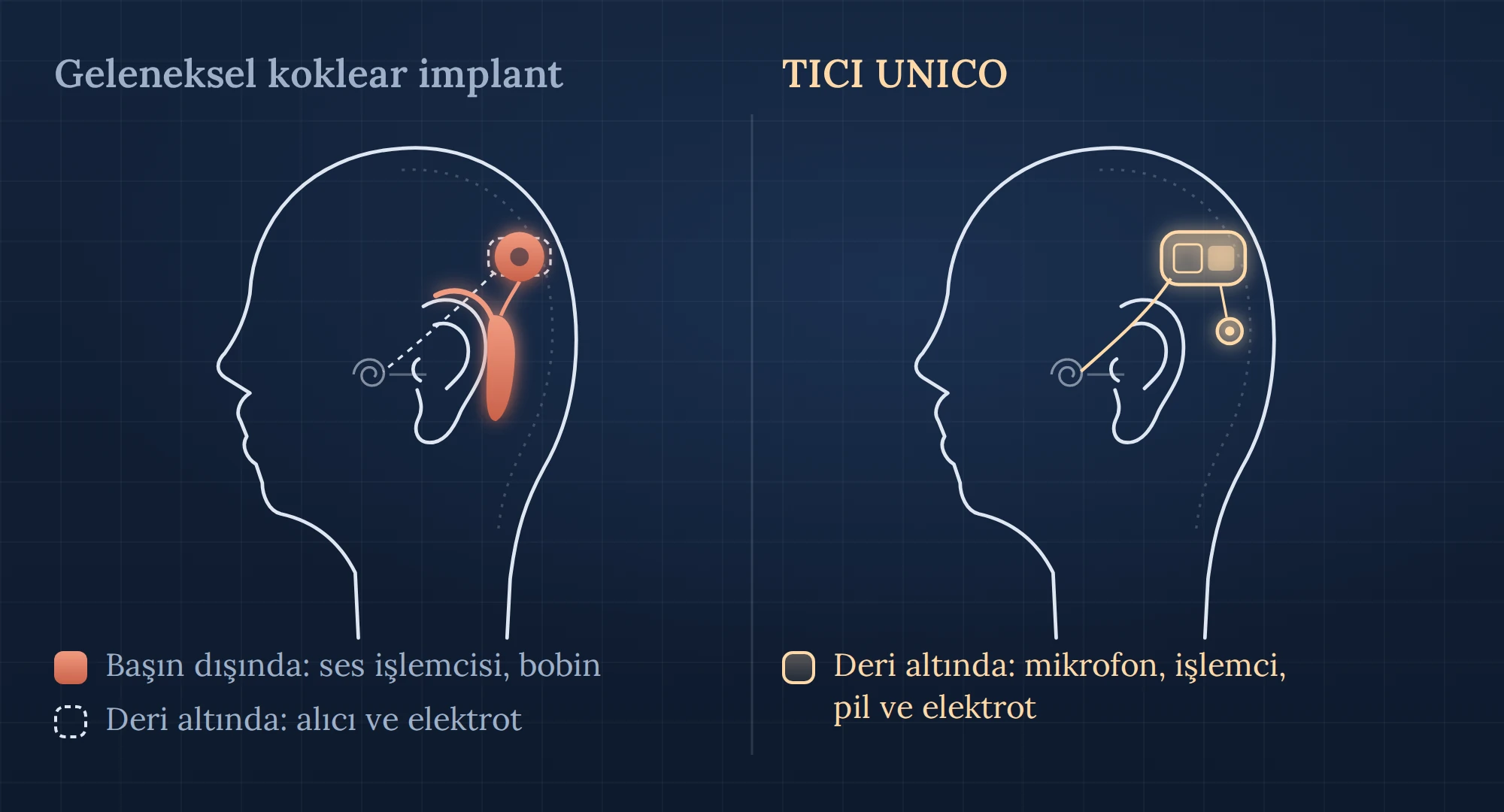 Geleneksel koklear implant ile TICI UNICO'nun parçalarını karşılaştıran çizim
