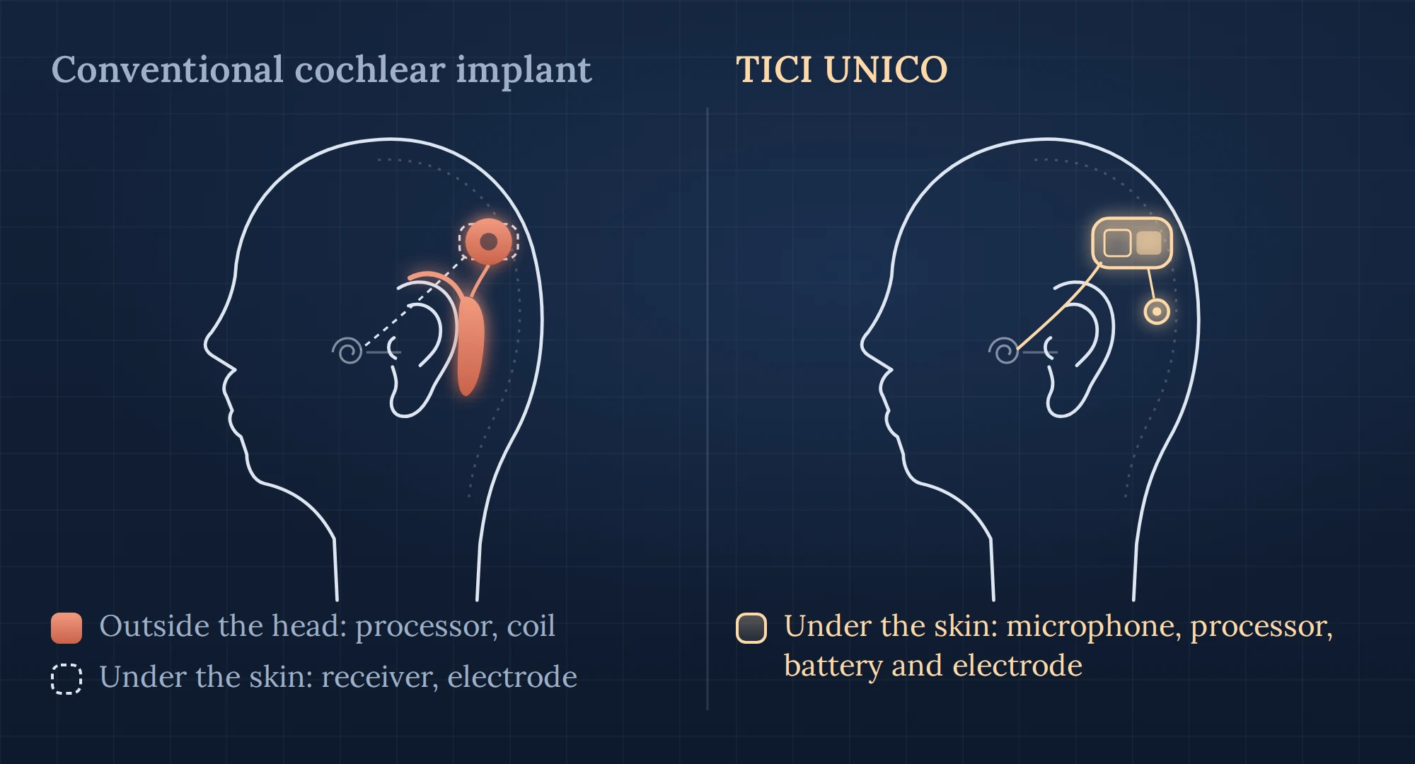 Drawing comparing the parts of a conventional cochlear implant and TICI UNICO