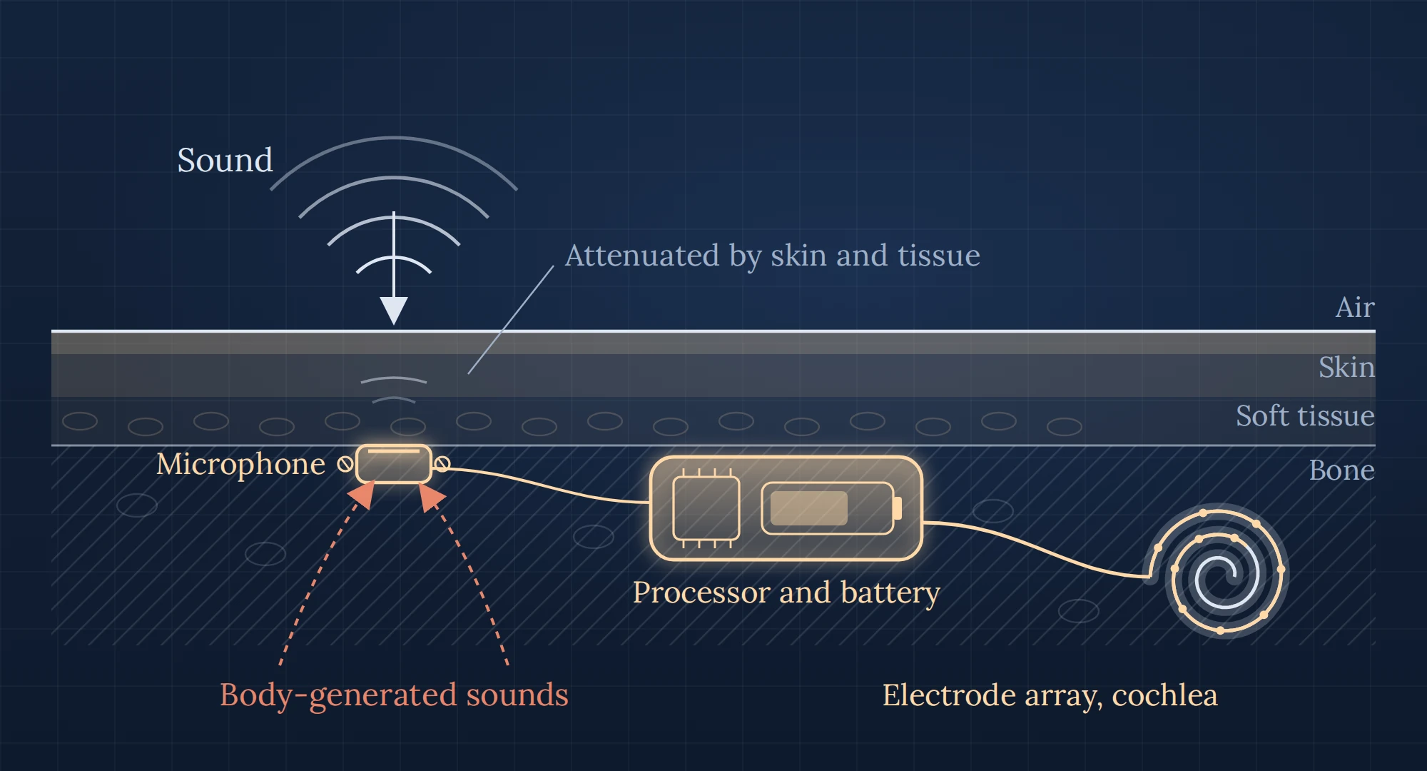 Cross-section drawing showing sound passing through skin and tissue to a subcutaneous microphone